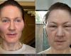 Tech Millionaire Bryan Johnson’s Face ‘Blows Up’ After Anti-Ageing Experiment Goes Wrong