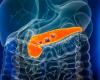 The scourge of pancreatic cancer