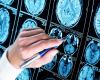 BRAIN TRAUMA and ALZHEIMER: What is the link?