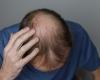 This Male Hair Loss Treatment Works Better Than Others