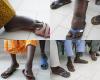 NEGLECTED TROPICAL DISEASES, A PAINFUL REALITY IN KHOMBOLE