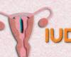 Hormonal IUD and risk of breast cancer