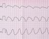 first-line ablation, a defensible option