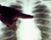 Tangier: MPs warn of the worrying increase in the number of tuberculosis cases