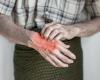 Heated mittens show promise in relieving osteoarthritis pain and stiffness