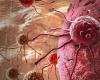 New immunotherapy shows long-term benefits in preventing squamous cell carcinoma