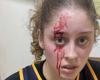 Basketball: the daughter of this tennis legend finishes her match with 40 points… and a bloody face