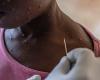 Mpox: a first case of the new variant identified in France, announces the Ministry of Health