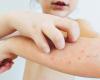 Measles outbreak ends in Fredericton area