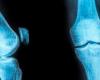 25% of women over 45 exposed to the risk of osteoporosis