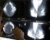 Artificial intelligence to detect breast cancer